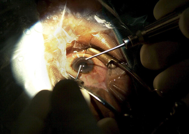 Bene test cornea artificiale, restituita vista a 14 pazienti © ANSA