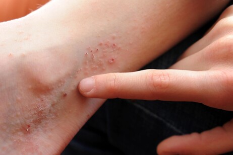Eczema, colpisce il 6% di bambini e adolescenti nel mondo