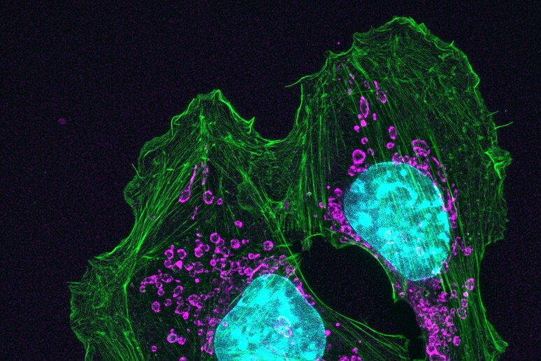 Cellule di un tumore della pelle (fonte: Catherine e James Galbraith, Oregon Health and Science University, Knight Cancer Institute, da Flickr) - RIPRODUZIONE RISERVATA