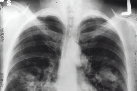 Tumore del polmone, paura e stigma frenano lo screening (free via unsplash)