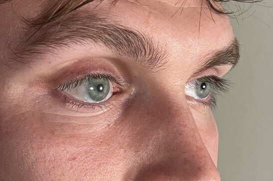 La protesi oculare è del tutto identica all’occhio sinistro sano del paziente (fonte: Stephen Bell, Ocupeye Ltd)