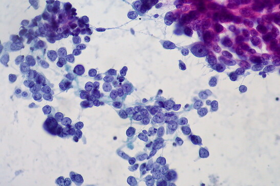 Cellule dell'adenocarcinoma del polmone (fonte: Ed Uthman from Houston, TX, USA, da Wikipedia)