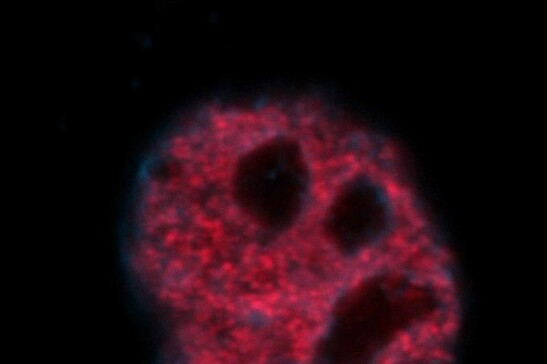 Cellule di carcinoma della cervice uterina trattate con un farmaco chemioterapico che induce un danno al Dna. In rosso il Dna danneggiato, in blu il DNA totale (fonte: A. Giordano, Temple University)